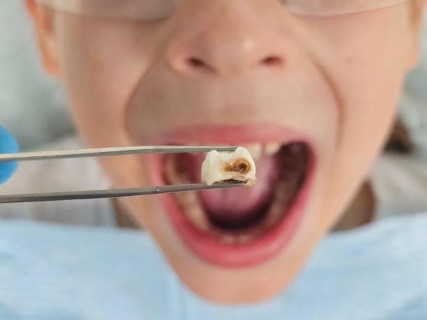 Best Emergency Dental Extractions in Woodinville, WA